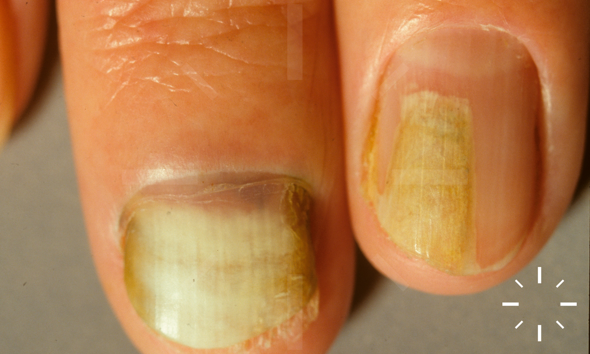 VW Dermatology - Onychomycosis, also known as tinea unguium, is a fungal  infection of the nail. Symptoms may include white or yellow nail  discoloration, thickening of the nail, and separation of the