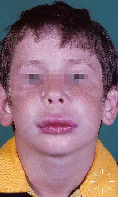 Dermacompass - Angioedema