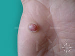 Granuloma pyogenicum