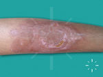 Pyoderma gangrenosum