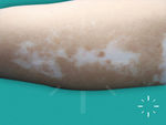 Vitiligo