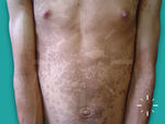 Pityriasis versicolor